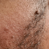 Image of 2 facial skin tags in the bearded area of a man
