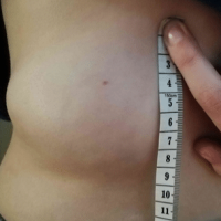 image of a very large Lipoma left lower back