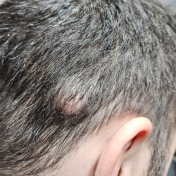 Image of a larger head cyst