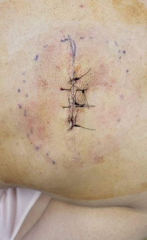 Image of the resulting scar after Lipoma removal