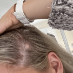 Image of a scalp cyst with some hair loss