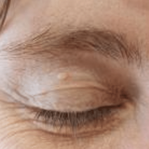 small wart on eyelid of a lady