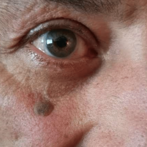 Wart in face of a man