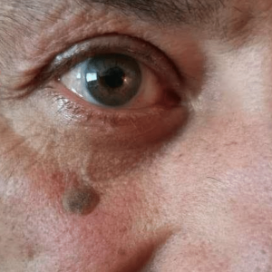 wart removal on face