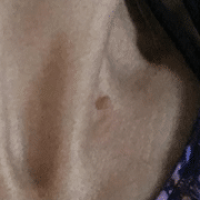 Image of a Skin tag on the neck