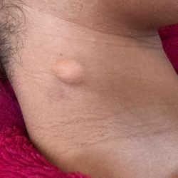 image of a cyst on the right neck in a young Asian lady