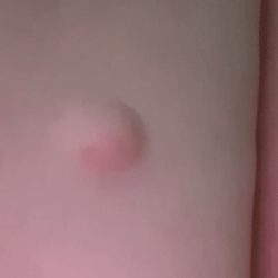 Cyst above back of knee of a young lady