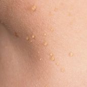 Skin Tag Removal Surgery £175 | Learn more about Skin Tags